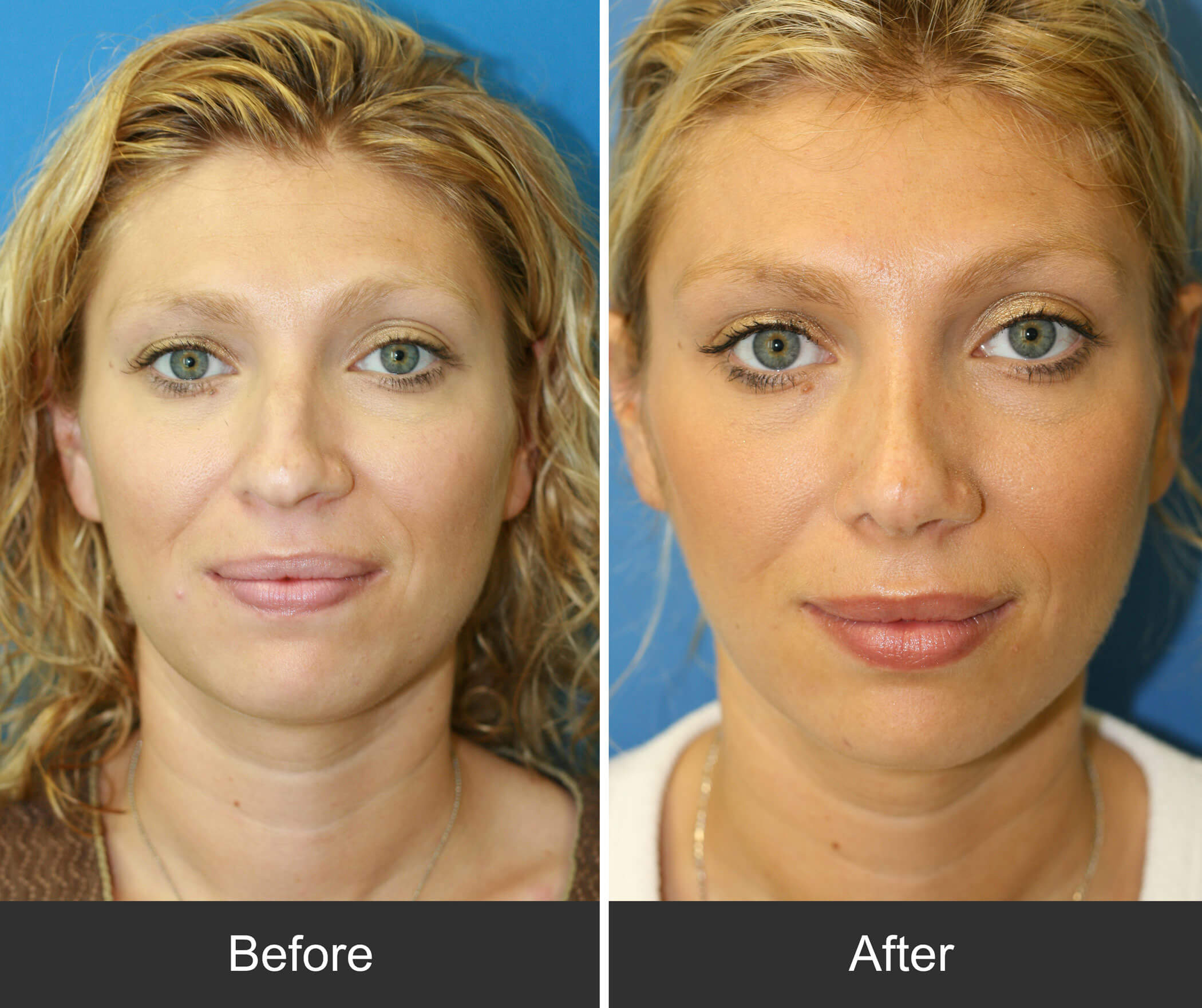 Patient3-front - Burlington Facial Surgery - Dr Korkis